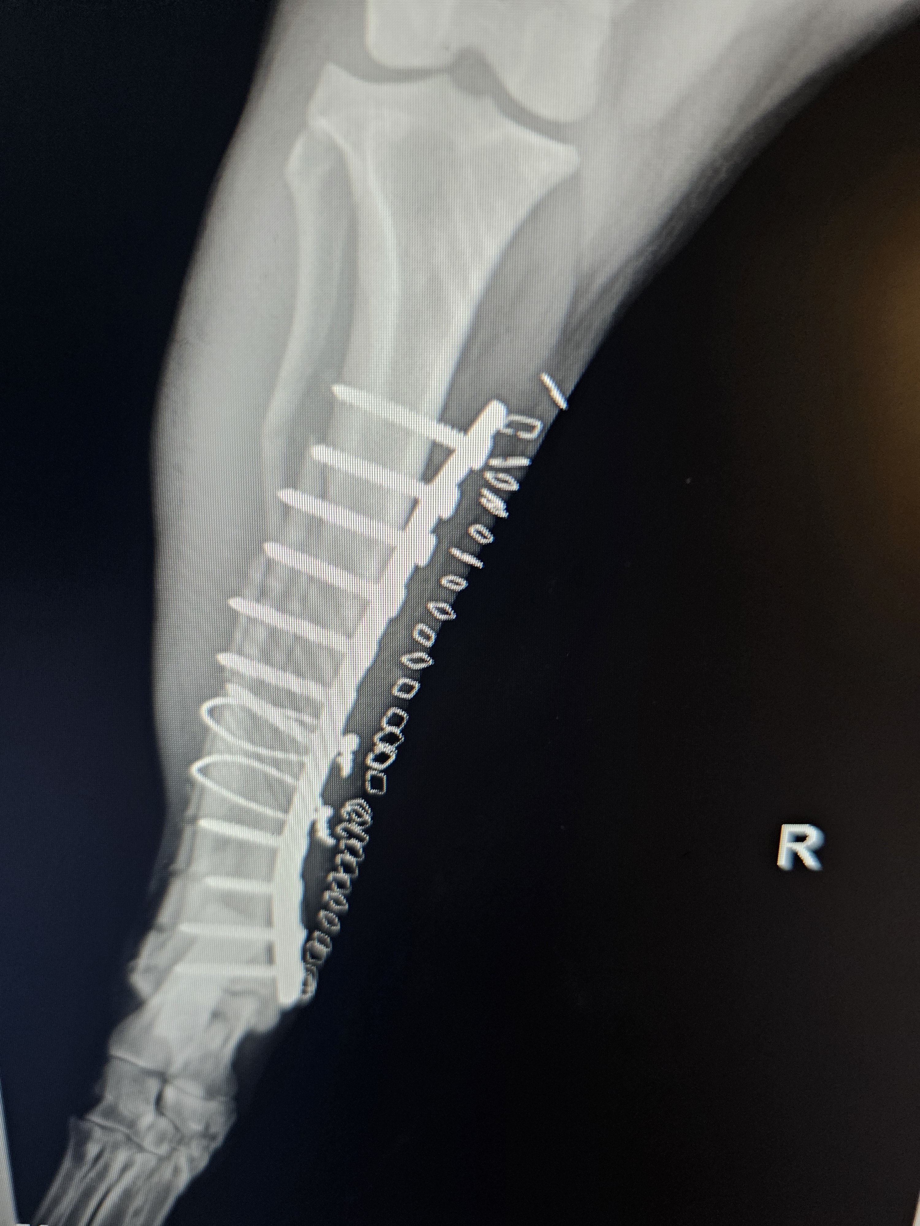 X-ray image of a right leg with a metal plate and screws