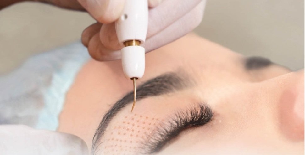 Non Invasive skin tightening