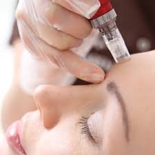 Microneedling treatment