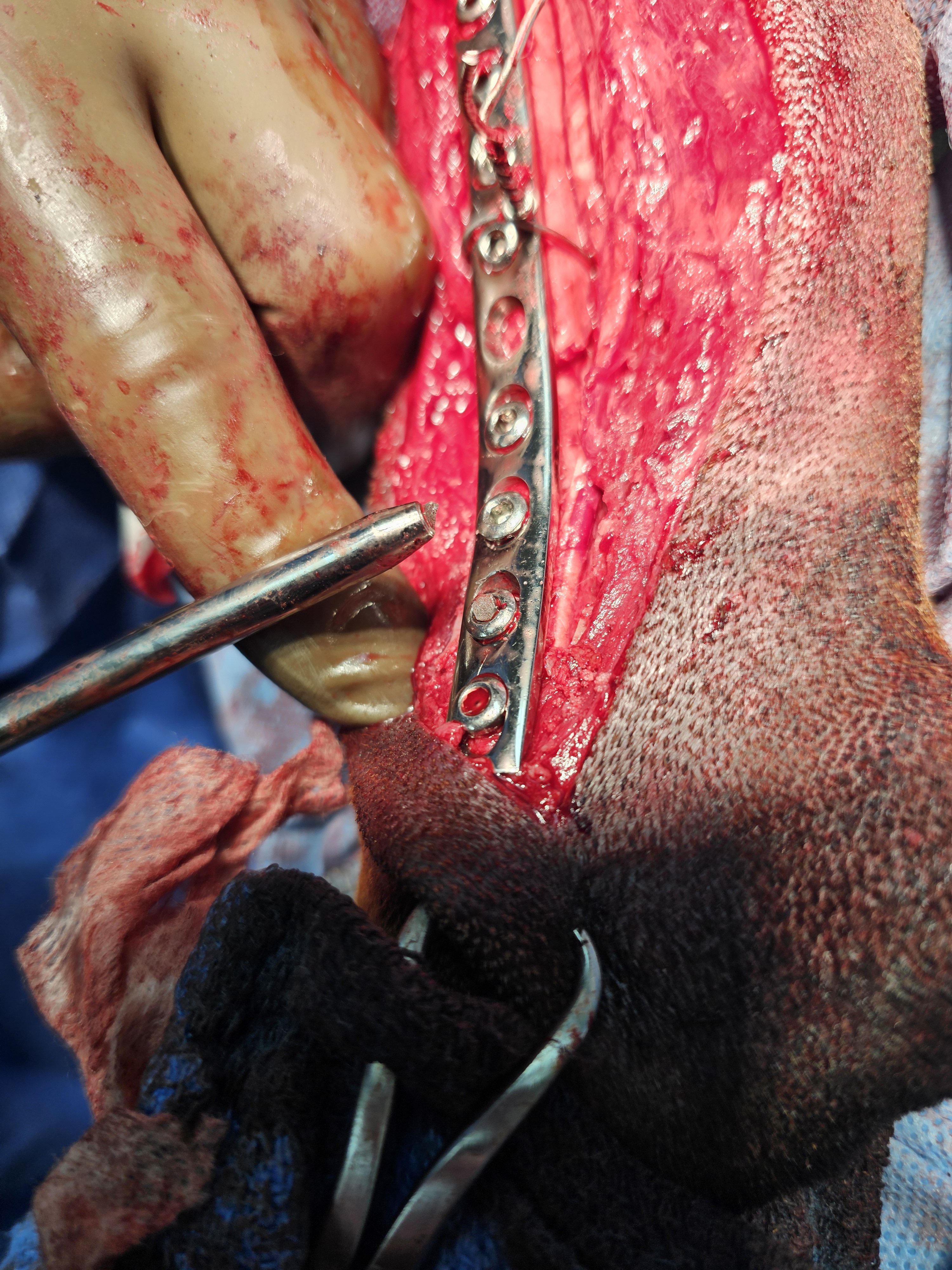 Surgical procedure with a metal plate and screws in place on a patient's leg
