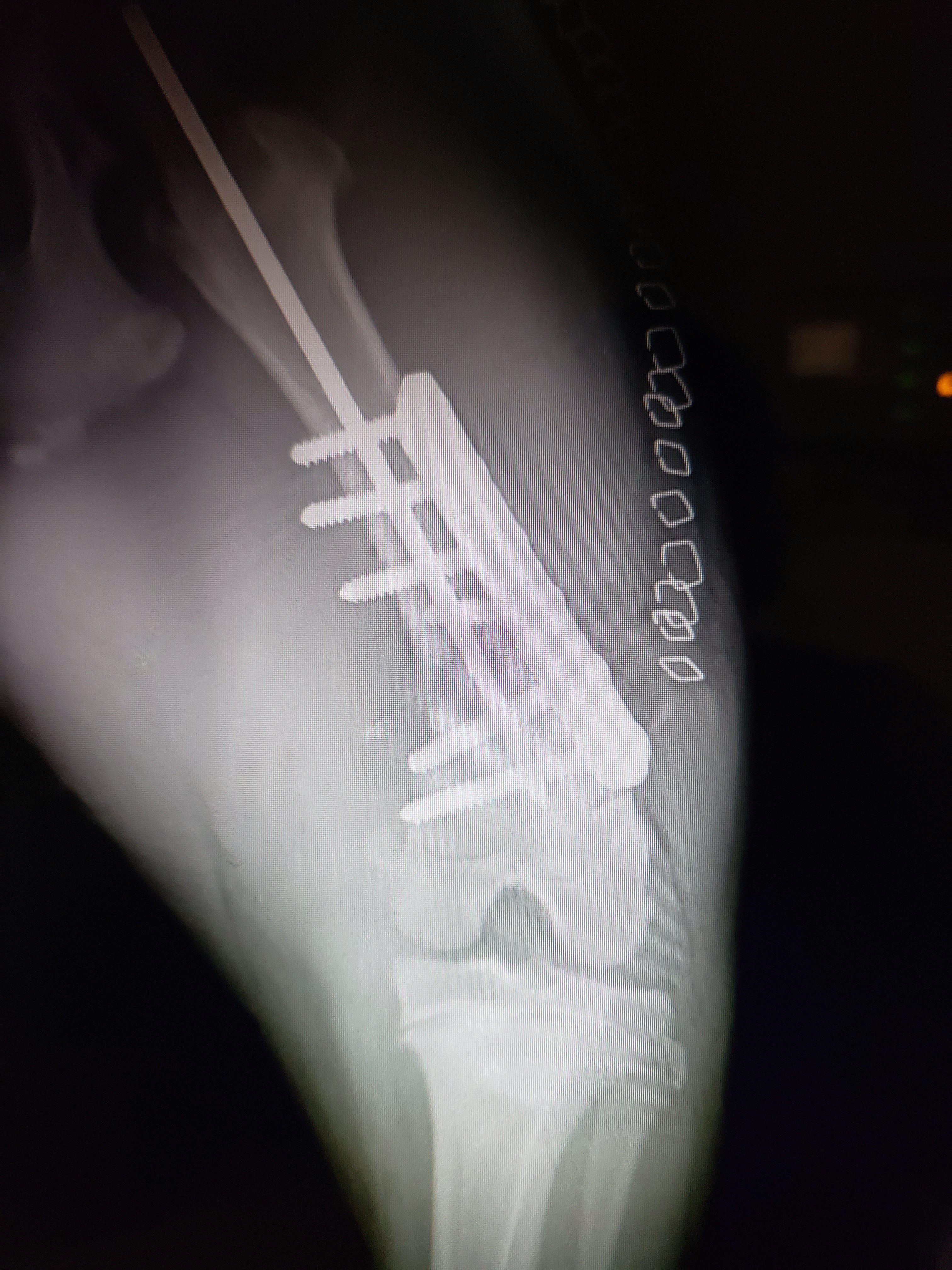 X-ray image of a leg with a metal rod and screws in place
